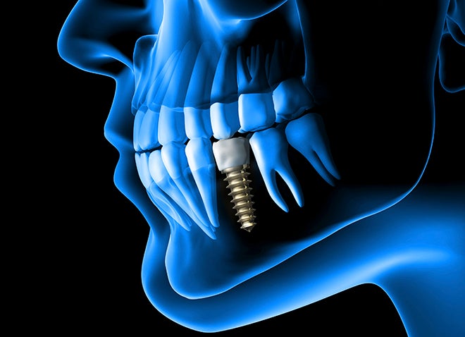Illustration of a human head in a transparent blue against a black background, showing an X-Ray-like view of the teeth and featuring a metal dental implant.