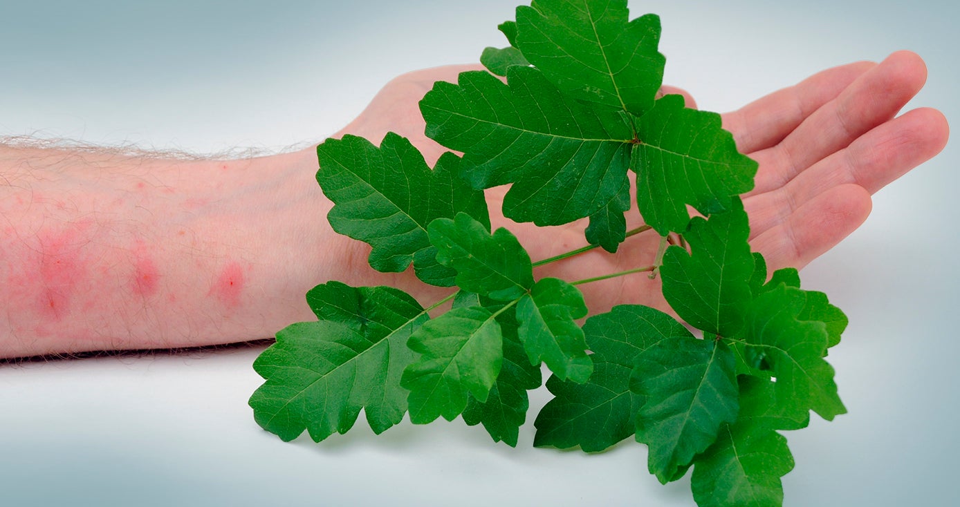 a pale arm with red spots from poison ivy, which is in the foreground